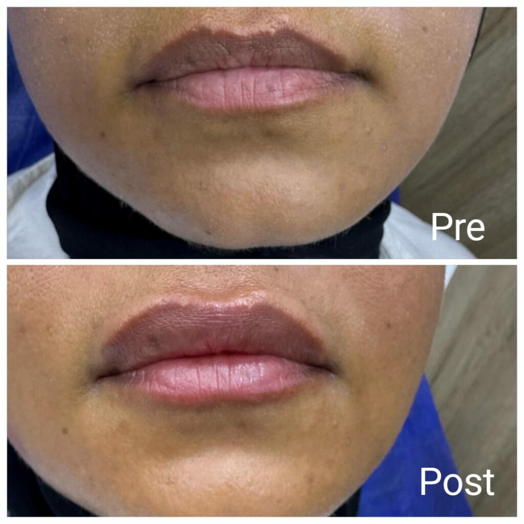 فيلر الشفايف قبل وبعد